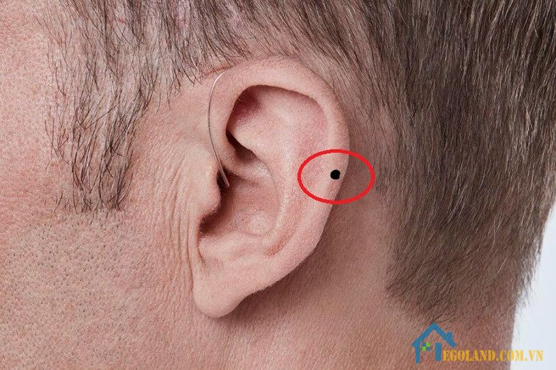 Nốt ruồi ở vành tai nam giới